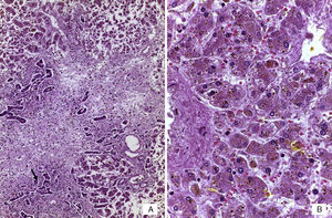 A) Panorámica del hígado con necrosis de hepatocitos en puente y proliferación de neocolangiolos (flecha). B) Colestasis hepatocelular y depósito de bilis en células de Kupffer (HE 400x).