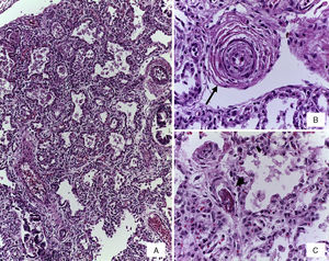 A) Engrosamiento de los tabiques interalveolares por infiltrado de linfocitos. B) Arteria preacinar con datos de enfermedad vascular pulmonar grado B (flecha). C) Trombo de fibrina en capilar (cabeza de flecha) (tinción con HE).
