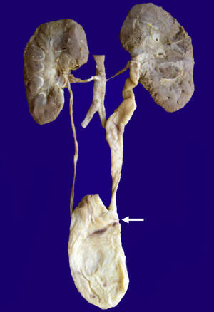El riñón izquierdo está aumentado de tamaño con uréter tortuoso y dilatado por implantación anormal en la vejiga (flecha).