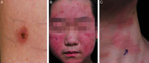 Case 1. (A) Mosquito bite hypersensitivity at 12 years of age. (B) Erythematous scaly skin lesion of the face at 15 years of age. (C) Similar skin lesion in the neck.
