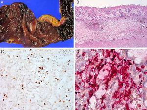 Case 1. (A) Perforated colon at 5 years of age. (B) Microscopic findings show acute and chronic inflammation with granulation tissue. (C) EBER in situ hybridization reveals EBV-positive lymphocytes. (D) EBV-positive lymphocytes are positive for CD3.
