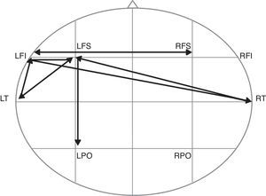 Scalp distribution of significant correlations of the theta relative power (TRP) during the lexical tone discrimination (LTD) in Zapotec. Left fronto-temporal (LFT) and right temporal (RT) sites engaged in the task are evident. LFI, left frontal inferior; LFS, left frontal superior; LT, left temporal; LPO, left parieto-occipital; RFI, right frontal inferior; RFS, right frontal superior; RT, right temporal; RPO, right parieto-occipital.