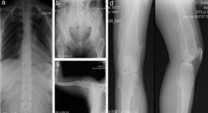 Caso 1 (II2). Paciente femenino de 40 años (madre) que presenta excrecencias óseas (exostosis) con manifestaciones en la unión esterno-costal de las primeras costillas y la parte superior del arco costal posterior (a), protuberancias óseas en cuellos femorales y región intertrocantérica con deformidad ósea (b), exostosis en región proximal de húmero (c) y tercio distal de fémur bilateral en región postero-medial y en borde postero-externo de tibia izquierda (d).