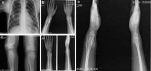 Caso 2 (III1). Paciente masculino de 12 años con exostosis en cuello y tercio proximal de húmero, quinto arco costal anterior derecho (a), en región anterolateral de ambos cúbitos, lo que sugiere una deformidad tipo III de la clasificación de Masada (b), tercio distal de fémur con ensanchamiento metadiafisiario (c), y protuberancias en región anterolateral de tibia y cúbito derechos, las cuales aumentaron de tamaño al año siguiente con mayor volumen de las lesiones de ambos cúbitos, principalmente el derecho (d, e).