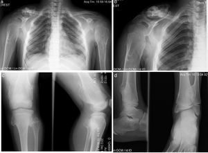 Caso 3 (III2). Paciente masculino de 8 años que presenta lesiones osteocartilaginosas con patrón heterogéneo de predominio radiolúcido en región clavicular derecha (a), exostosis en submetafisiarias en región proximal de húmero derecho (b), tercio distal de fémures (c), porciones proximal y distal de tibia y peroné (c, d). Hay deformidad con ensanchamiento medular en húmeros y fémures, principalmente. Las regiones fisiarias no están comprometidas.