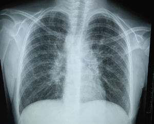 Adenopatías hiliares bilaterales e infiltrado pulmonar micronodular y reticular difuso.