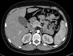 Tomografía abdominal posterior al tratamiento, donde se observa la remisión de las adenopatías retroperitoneales, y desaparición del cálculo renal derecho.