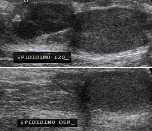 Ultrasonido testicular en el que se observa el epidídimo izquierdo aumentado de volumen y el epidídimo derecho normal.