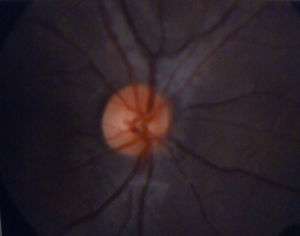 Fondo de ojo en el que se observa periflebitis temporal y nasal inferior.