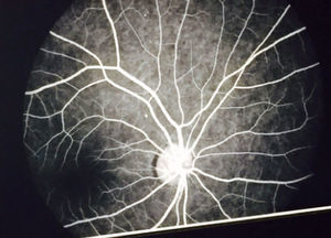 Fluorangiografía retiniana con trayectos vasculares sin alteraciones.