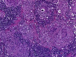 Biopsia de ganglio linfático con granulomas no caseificantes.