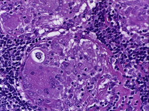 Biopsia de ganglio linfático donde se aprecian cuerpos de Schaumann.