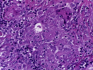 Biopsia de ganglio linfático con cuerpos asteroides.