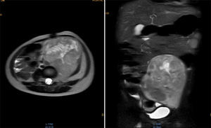 Resonancia magnética de abdomen con contraste que muestra masa sólida de 107×80×76mm de diámetros craneocaudal, anteroposterior y transverso que ocupa hipogastrio, fosa iliaca y flanco izquierdos y gran parte del mesogastrio, pediculada desde los agujeros de conjunción L4-L5, L5-S1 y S1 izquierdos. Sólida, heterogénea, con necrosis, vascularizada, que envuelve parcialmente la bifurcación aórtica y totalmente la arteria iliaca primitiva izquierda y sus ramificaciones, al igual que la vena iliaca.