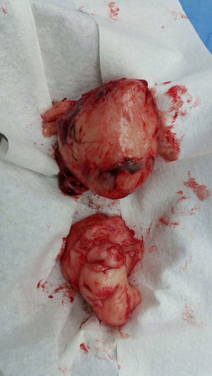 Pieza quirúrgica, muestra la porción del tumor que pudo resecarse.