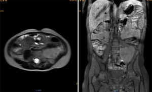 Resonancia magnética de abdomen con contraste mostrando a nivel paravertebral izquierdo masa de bordes definidos de aspecto heterogéneo en todas las secuencias, que mide aproximadamente 42.2×53.6mm, con ávido realce de la lesión con el medio de contraste.