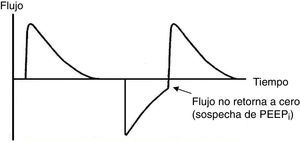 Curva de flujo-tiempo, atrapamiento aéreo. En la fase espiratoria de la curva de flujo-tiempo se muestra que el flujo no alcanza el eje de las abscisas, por lo que se debe sospechar la presencia de presión positiva intrínseca al final de la espiración (PEEPi).