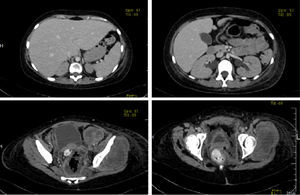 Se hizo tomografía con medio de contraste en donde se encontró hepatomegalia, e hidronefrosis bilateral. En cortes inferiores, la tumoración está presente.