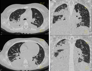 En la ventana para pulmón y mediastino se observaron conglomerados ganglionares, derrame pleural de lado derecho, broncograma aéreo y consolidación basal bilateral de predominio derecho.