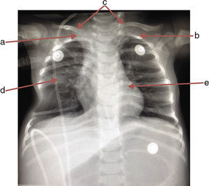 Radiografía anteroposterior de tórax donde se observa la ausencia de la primera costilla derecha (a), hipoplasia en la primera costilla izquierda (b), inserción aberrante de ambas clavículas (c), sexto y séptimo arcos costales fusionados en hemitórax derecho (d) y vértebras T6 y T7 en mariposa (e).