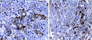 A. Los inmunomarcadores epiteliales fueron positivos en las áreas con formación de glándulas (citoqueratina 7). B. El componente sólido presenta diferenciación endocrina, evidente con los marcadores endocrinos (cromogranina).