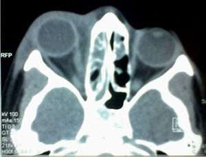 Tomografía axial computarizada de senos paranasales. Se observa un absceso subperióstico y preseptal derecho con celulitis extraocular.