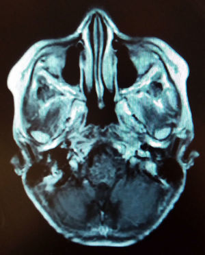 Los estudios de imagen informaron de una lesión de 4 x 5cm de características heterogéneas, con imágenes nodulares y reforzamiento más aparente en el lado derecho.