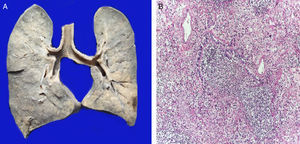 Los pulmones se encontraron aumentados de tamaño y peso. La superficie de corte muestra zonas de consolidación de color blanco (A). Los cortes histológicos muestran intenso infiltrado inflamatorio de leucocitos polimorfonucleares que destruyen la pared de un bronquiolo (B).