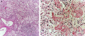 Se observó edema pulmonar, infiltrado inflamatorio de linfocitos y macrófagos intraalveolares con material de color café y aspecto granular (A). Se encontró daño alveolar difuso con formación de membranas hialinas (B).