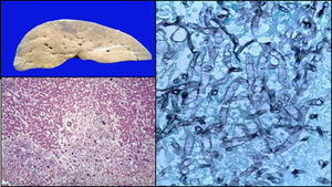 Lesiones subcapsulares de hígado; microscópicamente se observan granulomas con hifas de Aspergillus (Izquierda: HE 10x; derecha: Grocott 40x).