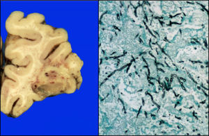 Corteza frontal con lesión de fondo necrótico-hemorrágico; microscópicamente se observan hifas de Aspergillus (Grocott 10x).