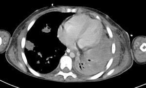 Tomografía de tórax con ventana para mediastino donde se observan nódulos en región basal derecha con zonas de ocupación alveolar de pulmón izquierdo.