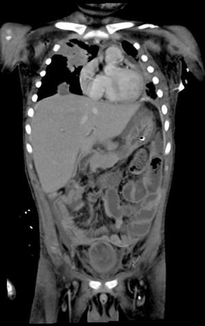 Tomografía toracoabdominal con presencia de nódulos pulmonares y datos de engrosamiento de la mucosa intestinal en forma generalizada.