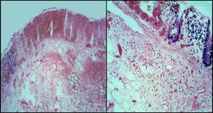 Los cortes histológicos de colitis neutropénica con mucosa de colon con necrosis y hemorragia extensa, edema de la submucosa, infiltrado inflamatorio linfocitario, sin evidencia de neutrófilos (hematoxilina-eosina (HE) 10x).