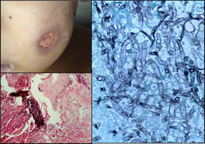 Lesiones escavadas de piel. Corte histológico de piel con necrosis de la epidermis y de la dermis, infiltrado inflamatorio linfocitario (HE 5x), asociada con hifas septadas con gemación dicotómica, que son morfológicamente compatibles con Aspergillus (Grocott 40x).