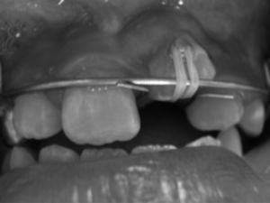 Tracción del diente impactado durante 2 meses y reubicación del botón.