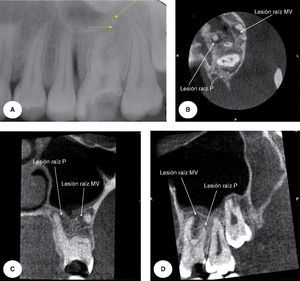 Mujer de 23 años de edad que acudió a la clínica de diagnóstico de la Facultad de Odontología de la Universidad de Chile, para restaurar un molar superior (diente 2.6), el que presentaba una extensa caries coronaria, sin sintomatología clínica. La radiografía convencional muestra 2 lesiones radiolúcidas periapicales ubicadas en la raíz palatina y mesio vestibular, señaladas con fechas amarillas (A). La exploración volumétrica, CBCT (3D ProMax Planmeca, Helsinki, Finlandia) en los 3 planos axial (B), coronal (C) y sagital (D), reveló en total 3 lesiones periapicales en sus reales dimensiones. En este conjunto de imágenes, es posible observar una lesión en la raíz disto vestibular que no fue identificada con la radiografía convencional.