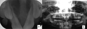Radiografías oclusal y panorámica (a y b, respectivamente) en donde se observa una zona radiolúcida multiloculada que va desde la línea media anterior al paladar duro con evidente desplazamiento dental con preservación de la espina nasal anterior