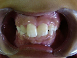 Imagen postoperatoria (18 meses) donde se observa el alineamiento dental y disminución del aumento de volumen.