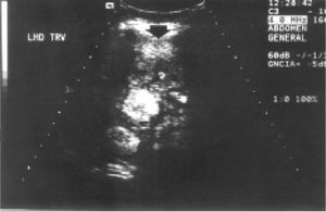 Liver ultrasonogram showing a 10 cm hyperechoic mass in the right hepatic lobule, with a fluid component corresponding to hemorrhage.