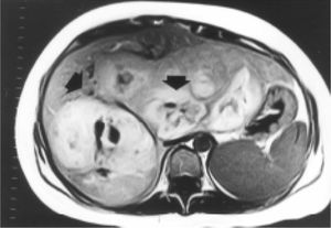 On the transverse T1-weighted MR image, multiple adenomas are moderately hyperintense relative to the liver parenchyma.