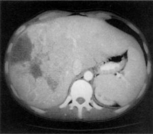 A CT scan of the liver show a nodular, hipodense and hetergeneus lesion in the right lobule.