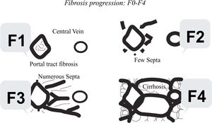 The METAVIR Fibrosis staging system F0 is normal liver (no fibrosis). F1 = portal fibrosis. F2 = few septa. F3 = many septa. F4 = cirrhosis.