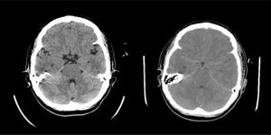 Rapid development of brain edema in a patient with fulminant hepatic failure. On the right, the TC scanner made at admission was normal. On the left, the TC scanner performed 8 hours later shows evident signs of brain edema.