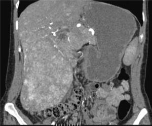 Coronal reconstruction of liver CT arteriogram at 7 weeks post-partum demonstrating a 12 cm exophytic liver mass off the inferior right lobe. (Courtesy of Ann McNamara, MD).