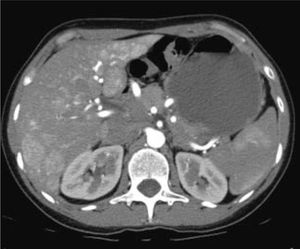Axial CT arteriogram image of the liver showing multiple arterially enhancing masses in both lobes of the liver. (Courtesy of Ann McNamara, MD).