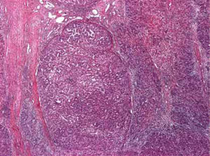 The neoplasm has a solid and nodular growth pattern, divided by thin, fibrous, connective tissue septum.