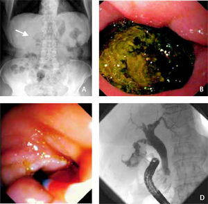 Panel A displays gas in the extrahepatic bile ducts on plain abdominal X-ray in erect position (arrow). Panel B shows a large gallstone that filled the major part of the duodenal bulb upon upper gastrointestinal endoscopy. Panel C displays the opening of a small cholecytoduodenal fistula upon duodenoscopy. In figure 1D, application of contrast media via the fistula is shown. The small contracted gallbladder contained a second gallstone whereas the cystic duct, the common bile duct and the intrahepatic bile ducts were free of calculi.