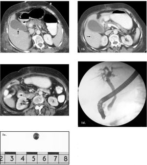 Contrast enhanced CT demonstrating a small calcified gallstone (arrow) within the gallbladder. 1b+c. Contrast enhanced CT two weeks later. b. A dilated gallbladder with thickened wall, absence of stone, and intrahepatic bile duct dilatation (arrow). 1c. The migrated gallstone (arrow) is seen in the distal CBD. 1d. ERCP demonstrating a filling defect in the distal CBD. 1e. The extracted gallstone.