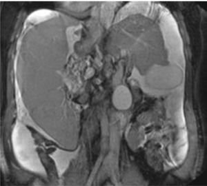 Image of the cirrhotic liver in the left upper quadrant at the time of orthotopic liver transplantation.